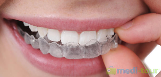 Aparat ortodontyczny (Clear Aligner, Invisalign)