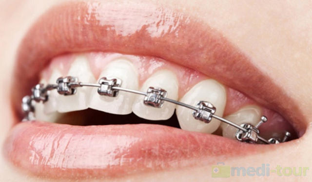 Aparat ortodontyczny - jak dbać o zęby