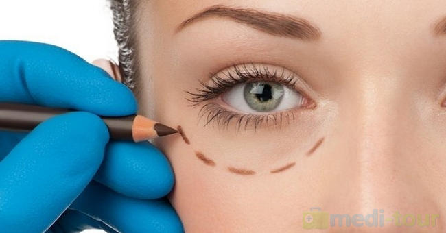 Korekcja, plastyka powiek - Blepharoplastyka