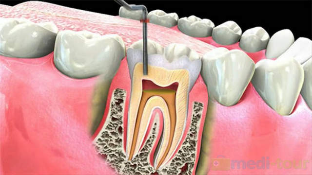 Leczenie kanałowe - endodontyczne