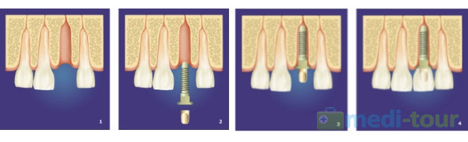 Zabieg wszczepienia implantu