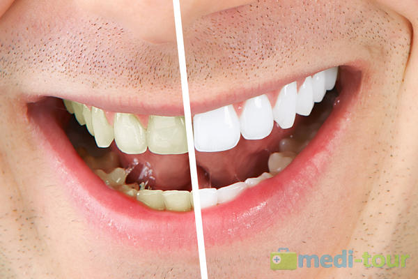 Wybielanie zębów przed i po